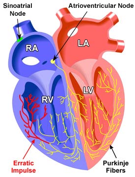 Arrhythmias