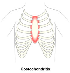 Costochondritis