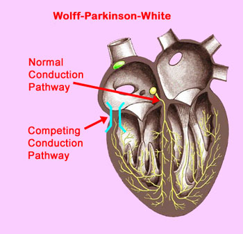 Wolff-Parkinson-White