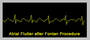 Atrial Flutter