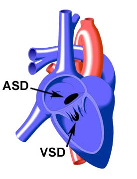 Endocardial Cushion Defect
