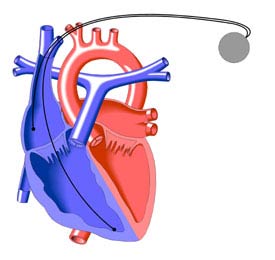 Pacemaker