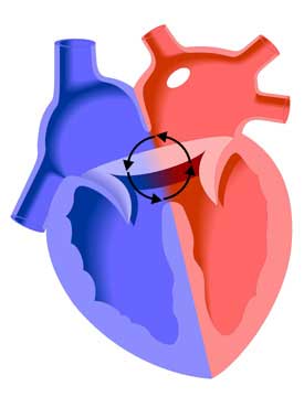 Atrioventricular Septal Defect