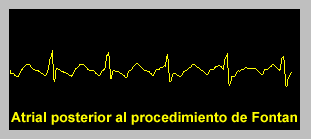 Atrial Flutter
