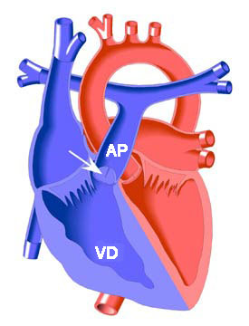 Pulmonary Stenosis