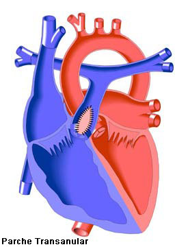 Transannular Patch