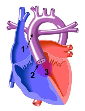 Truncus Arteriosus