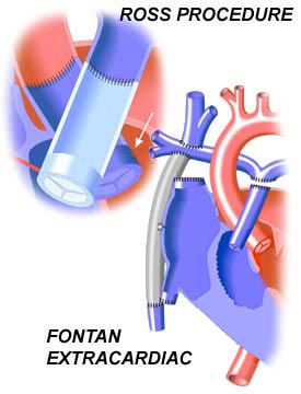 Valve Replacement